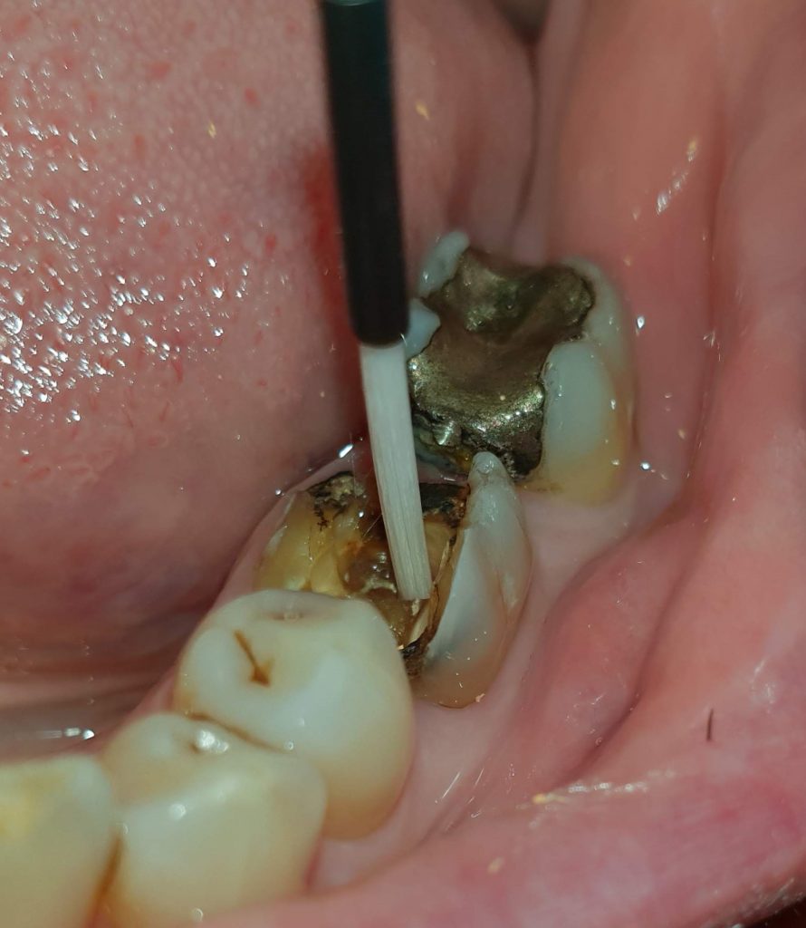 Präparation des defekten Zahns